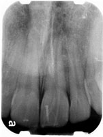 Periapical